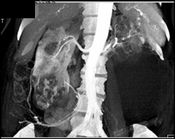 Renal Cell Carcinoma - CTisus CT Scan