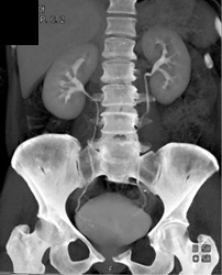 Ct Urogram - CTisus CT Scan