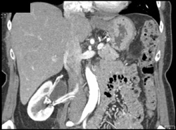 Ureteropelvic Junction (UPJ) Right Kidney - CTisus CT Scan