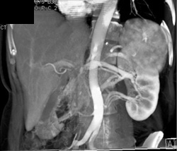 Multiple Renal Arteries - CTisus CT Scan