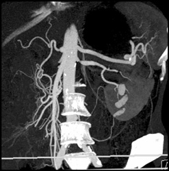 Stenosis Left Renal Artery - CTisus CT Scan