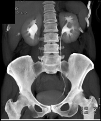 Ct Urogram - CTisus CT Scan