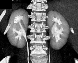 Mild Calyceal Dilation - CTisus CT Scan