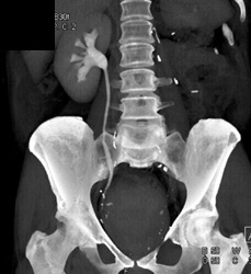 Ct Urogram - CTisus CT Scan