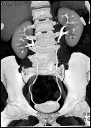 Ct Urogram - CTisus CT Scan