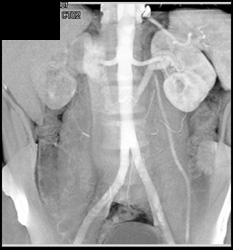 Retroaortic Renal Vein - CTisus CT Scan