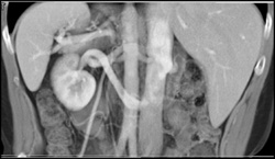 Retroaortic Renal Vein - CTisus CT Scan