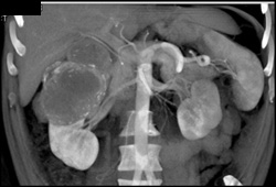 Renal Cell Carcinoma - CTisus CT Scan