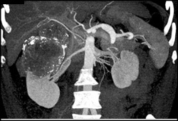 Renal Cell Carcinoma - CTisus CT Scan