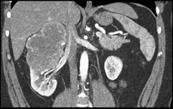 Renal Cell Carcinoma - CTisus CT Scan