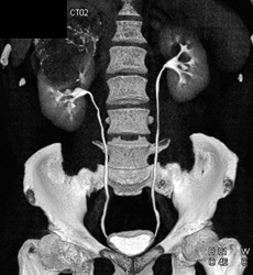 Renal Cell Carcinoma - CTisus CT Scan