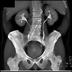 Dilated Prostate - CTisus CT Scan