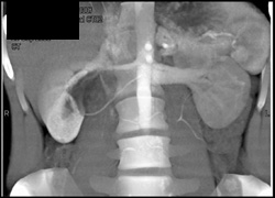 Ureteropelvic Junction (UPJ) of Right Kidney - CTisus CT Scan