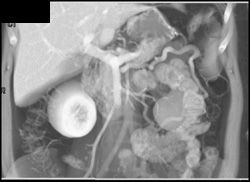 Varices Around Left Kidney - CTisus CT Scan