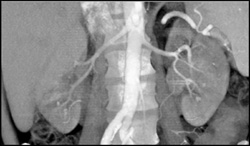 Left Renal Cell Carcinoma - CTisus CT Scan