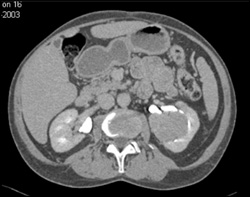 Renal Cell Carcinoma - CTisus CT Scan