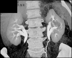 Renal Cell Carcinoma - CTisus CT Scan