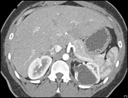 Obstructed Upper Pole M????y Left Kidney - CTisus CT Scan