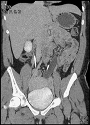 Ectopic Ureterocele - CTisus CT Scan