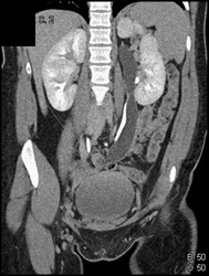 Duplicated Upper Pole Collecting System - CTisus CT Scan