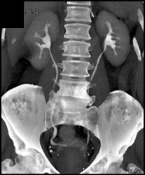 Ct Urogram - CTisus CT Scan