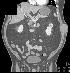 Renal Cell Carcinoma - CTisus CT Scan