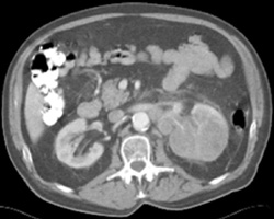 Transitional Cell Carcinoma - CTisus CT Scan