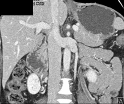 Clot in Gonadal Vein - CTisus CT Scan