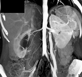 Left Gonadal Vein and Ureteropelvic Junction (UPJ) - CTisus CT Scan