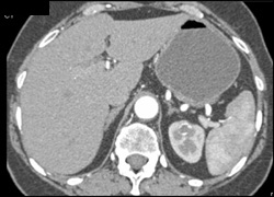 Subtle Calcified Renal Lesion - CTisus CT Scan