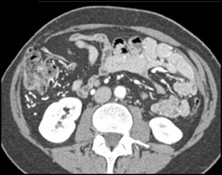 Unusual Collaterals Around the Right Kidney Best Seen in 3D - CTisus CT Scan