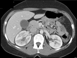 Acute Pyelonephritis - CTisus CT Scan