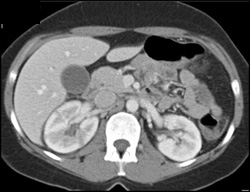 Acute Pyelonephritis - CTisus CT Scan