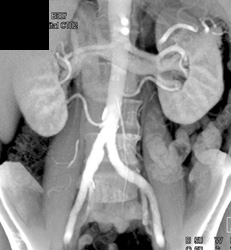 Bilateral Duplicated Renal Arteries - CTisus CT Scan