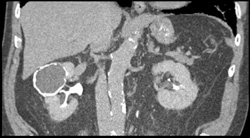 Calcified Hematoma Right Kidney - CTisus CT Scan