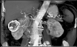 Calcified Lesions Right Kidney - CTisus CT Scan