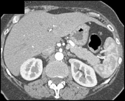 1 Cm Left Renal Cancer - CTisus CT Scan