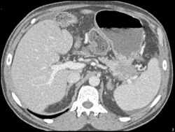 Pancreatic Cancer and Incidental Renal Cancer - CTisus CT Scan