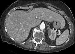 Renal Infarct - CTisus CT Scan