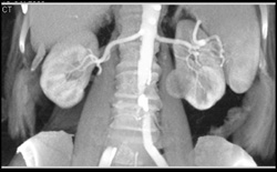 Renal Carcinoma - CTisus CT Scan