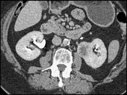 Renal Carcinoma - CTisus CT Scan