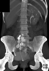 Stent in Pelvic Kidney - CTisus CT Scan