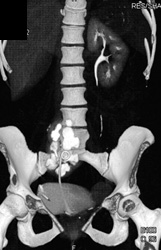 Stent in Pelvic Kidney With Dilated Calyces - CTisus CT Scan