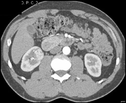 Vascular Renal Cell Carcinoma - CTisus CT Scan