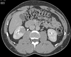 Renal Cell Carcinoma - CTisus CT Scan