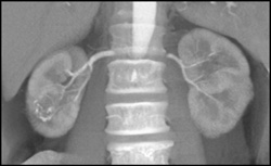 Calcified Rim to Renal Lesion - CTisus CT Scan