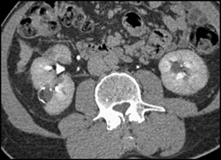 Cystic Bosniak 2 Lesion - CTisus CT Scan