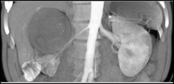 Renal Cell Carcinoma - CTisus CT Scan