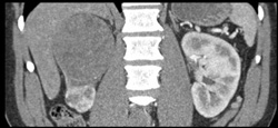 Renal Cell Carcinoma - CTisus CT Scan