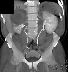 Renal Cell Carcinoma - CTisus CT Scan